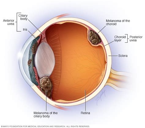 mole behind the eyeball.